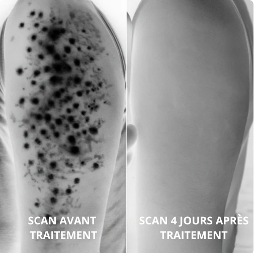 Strawbeauty - crème d'acide triple avancé pour la kératose pilaire