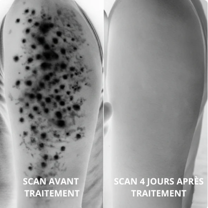 Strawbeauty - crème d'acide triple avancé pour la kératose pilaire