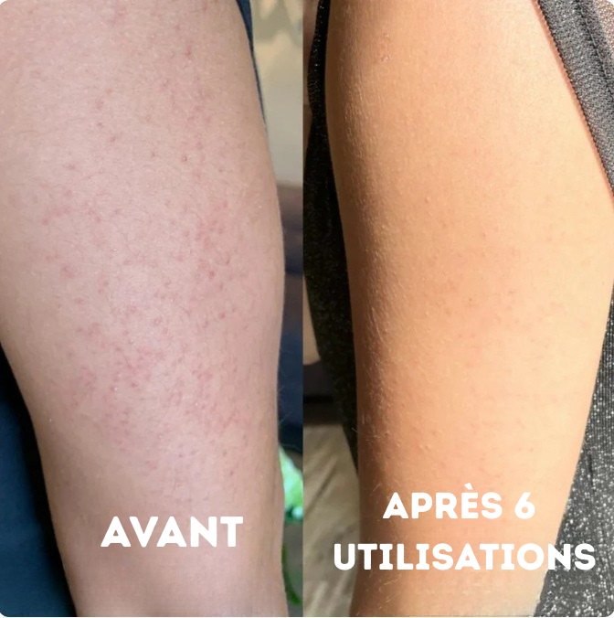 Strawbeauty - crème d'acide triple avancé pour la kératose pilaire